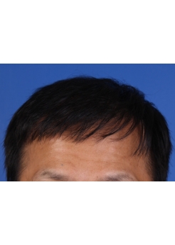 After Hair Transplant&nbsp;2 Sessions (Areas)